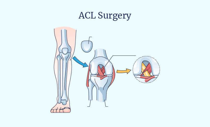 Acl Surgery cost in Nagpur