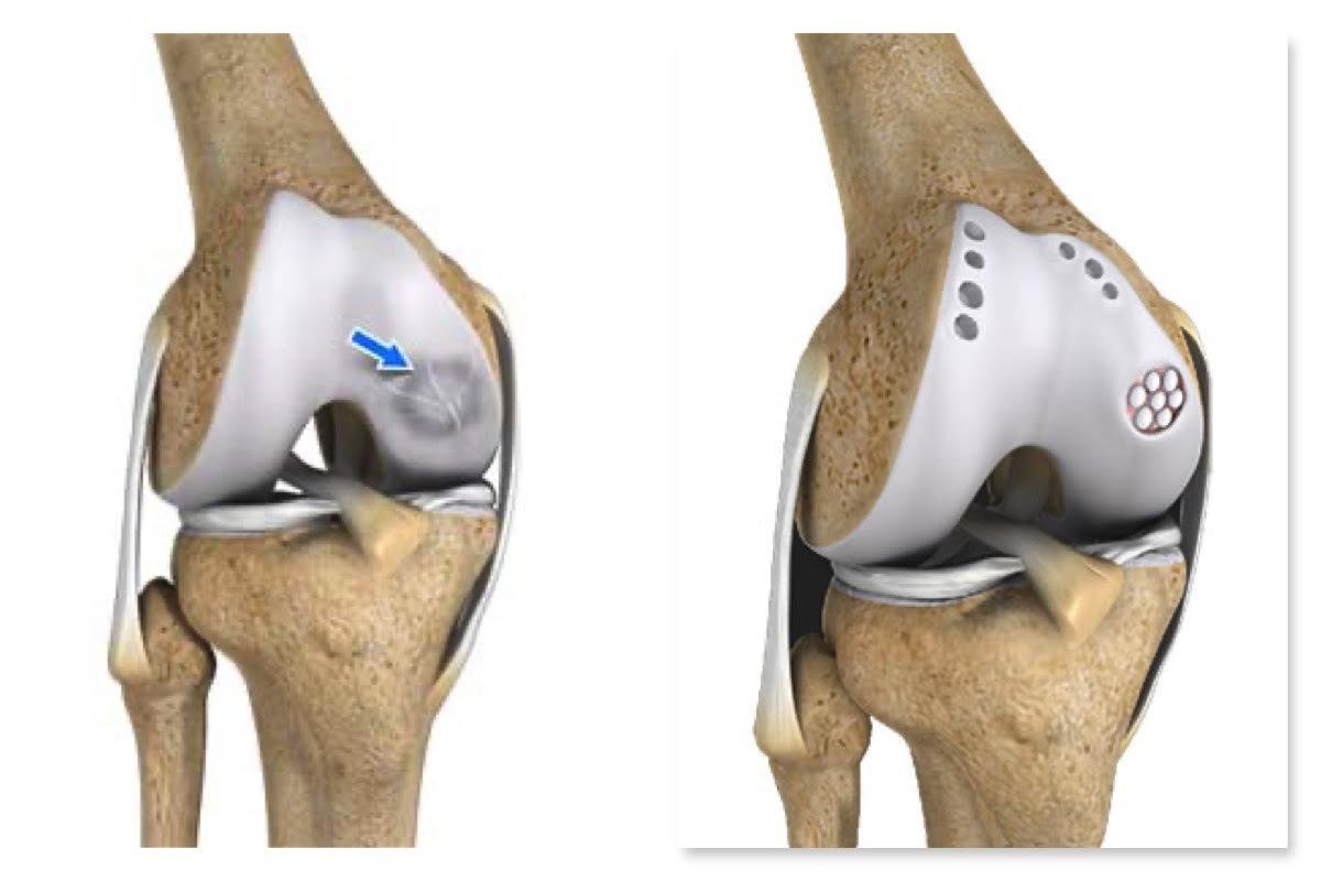 Knee Joint Preservation In Nagpur