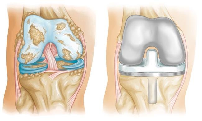 Knee Replacement In Nagpur