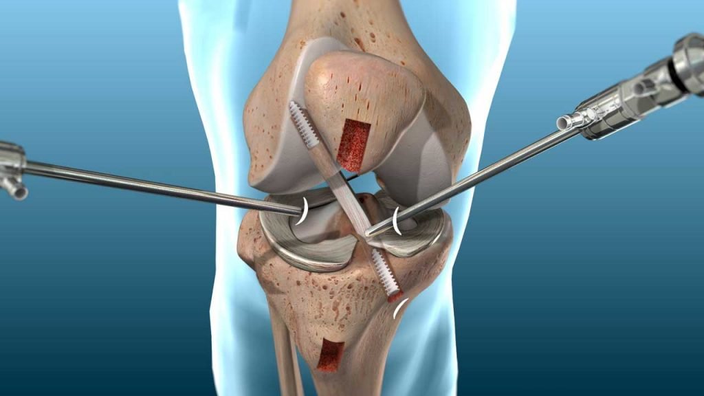 ACL Surgeon In Rewa