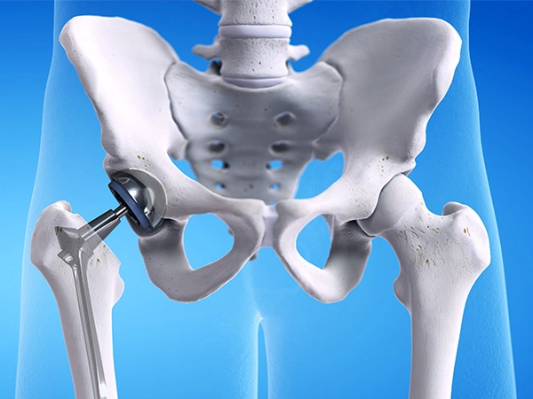 Best Hip Replacement Surgeon In Nagpur