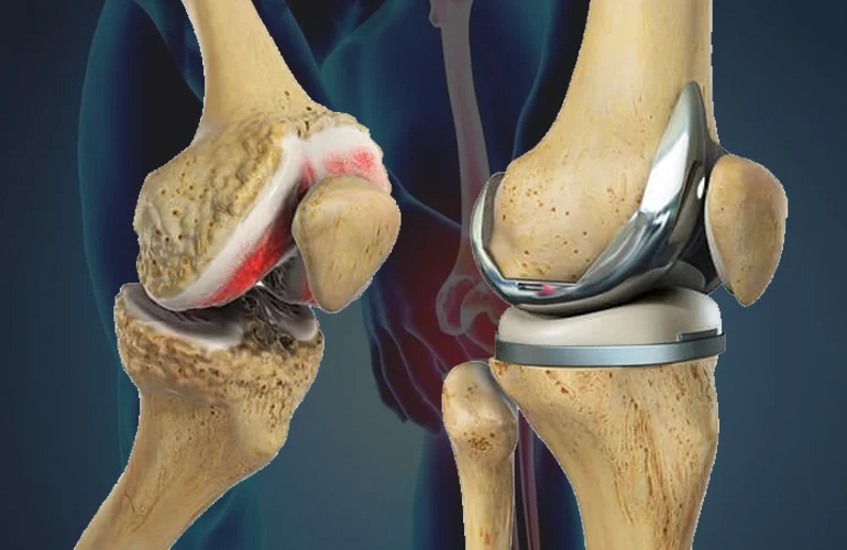Best Knee Replacement Surgeon in Nagpur – Dr. Ambar Daware