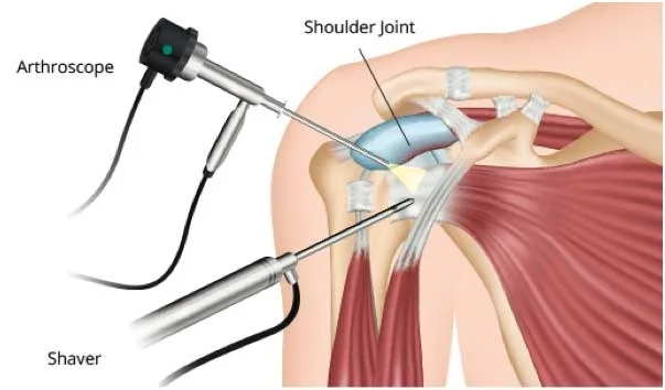 Best Shoulder Arthroscopy Surgeon In Nagpur