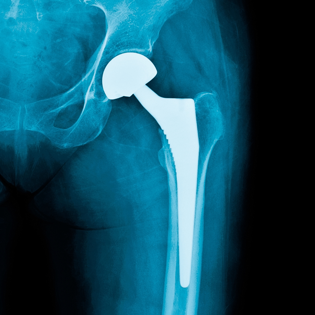Hip Replacement Surgeon In Adilabad