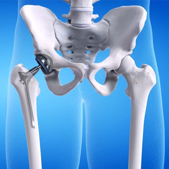 Hip Replacement Surgeon In Nagpur