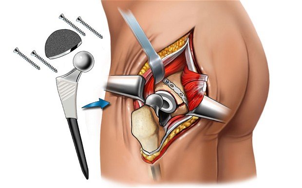 Hip Replacement Surgeon In Rewa