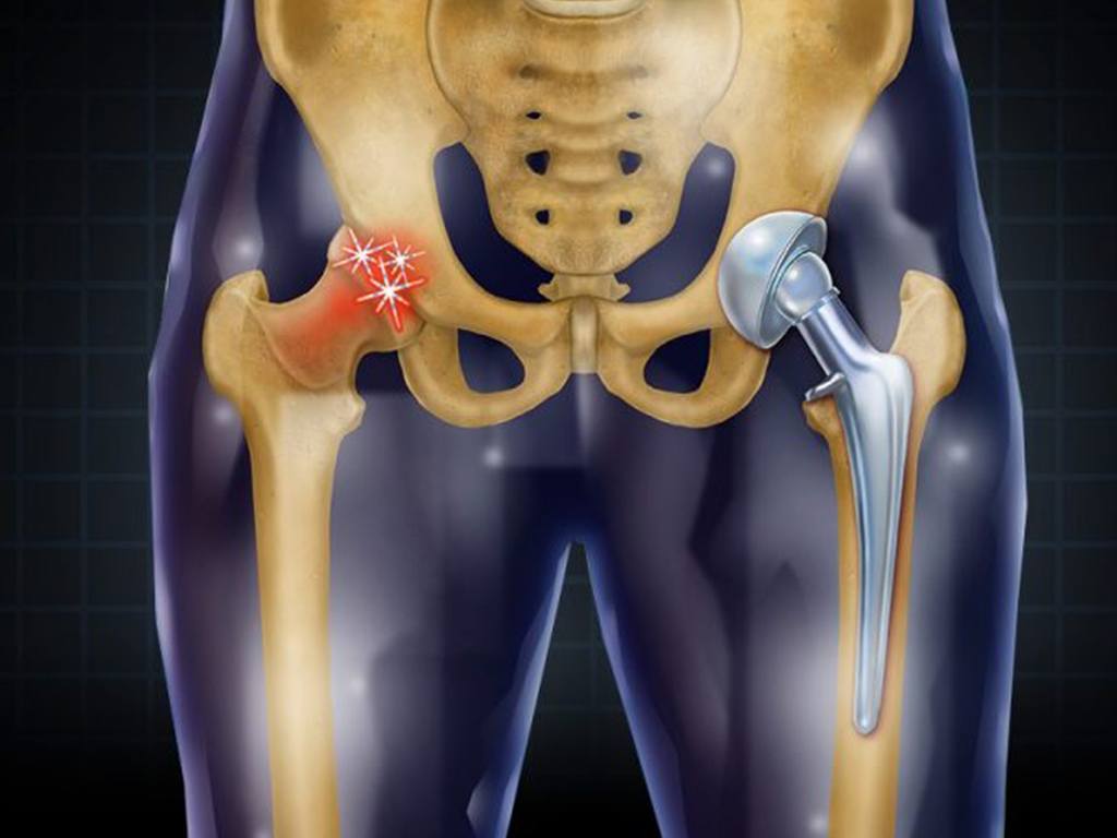 Hip Replacement Surgeon In Satna