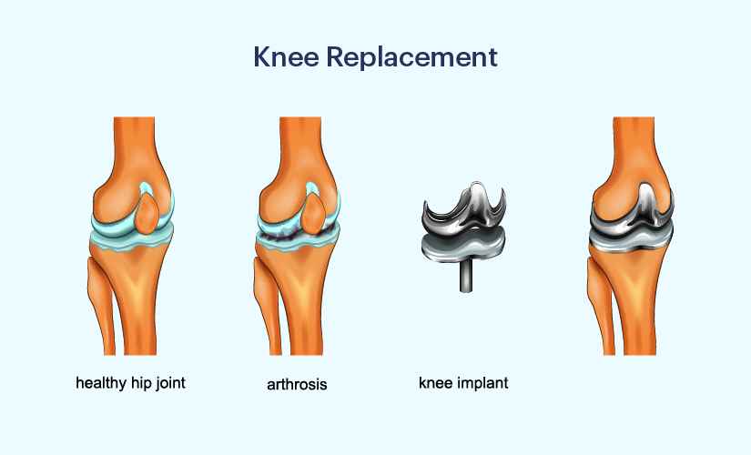 Knee Replacement surgery Cost In Nagpur