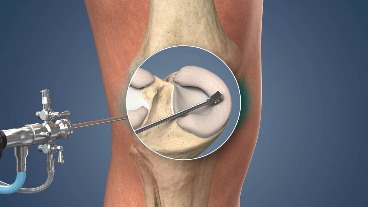 Meniscus Repair Surgery In Nagpur