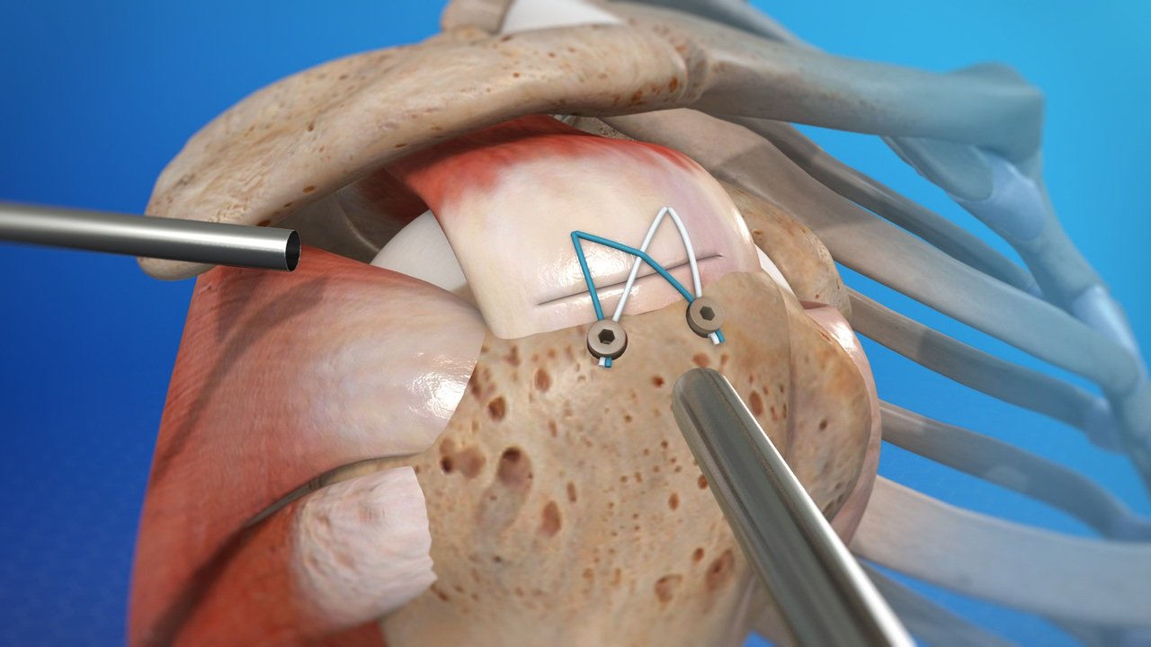 Rotator Cuff Tear Treatment In Nagpur