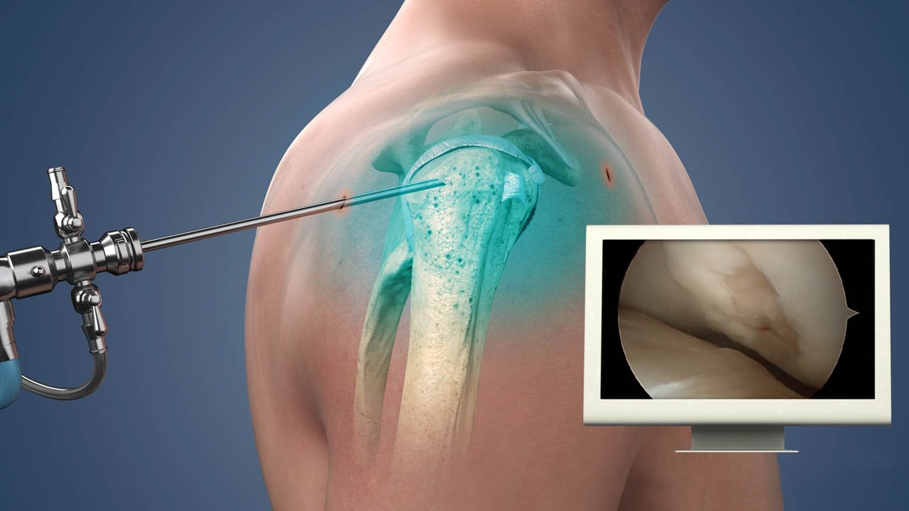 Shoulder Arthroscopy in Seoni