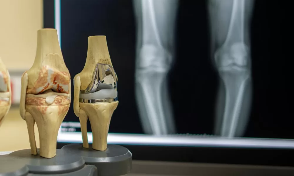 Top Knee Replacement Surgeon In Nagpur