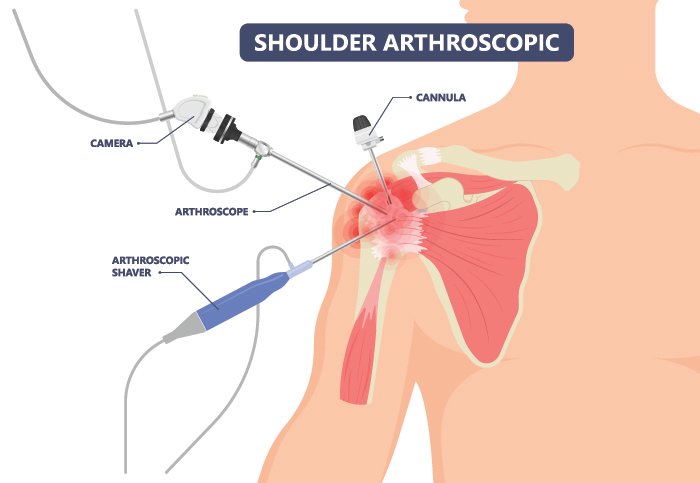 Shoulder Arthroscopy