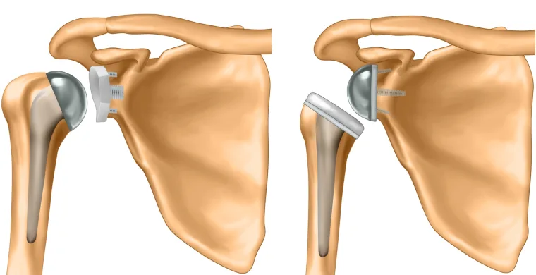 Shoulder Replacement
