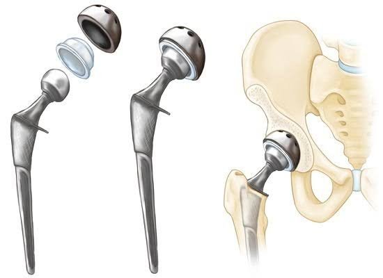 Hip Replacement Surgeon In Adilabad