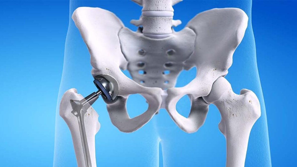 Hip Replacement Surgeon In Amravati