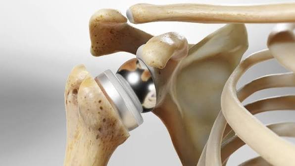 Reverse Shoulder Replacement In Nagpur