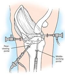 Shoulder Arthroscopy In Amravati